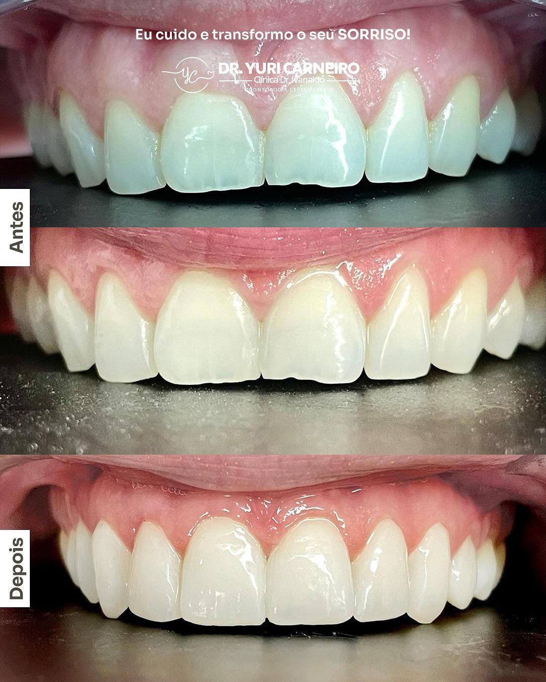 Gengivoplastia, clareamento e resina composta — registro original 1 de 5