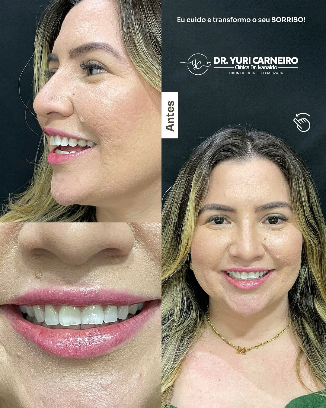 Gengivoplastia, clareamento e resina composta — registro original 2 de 5