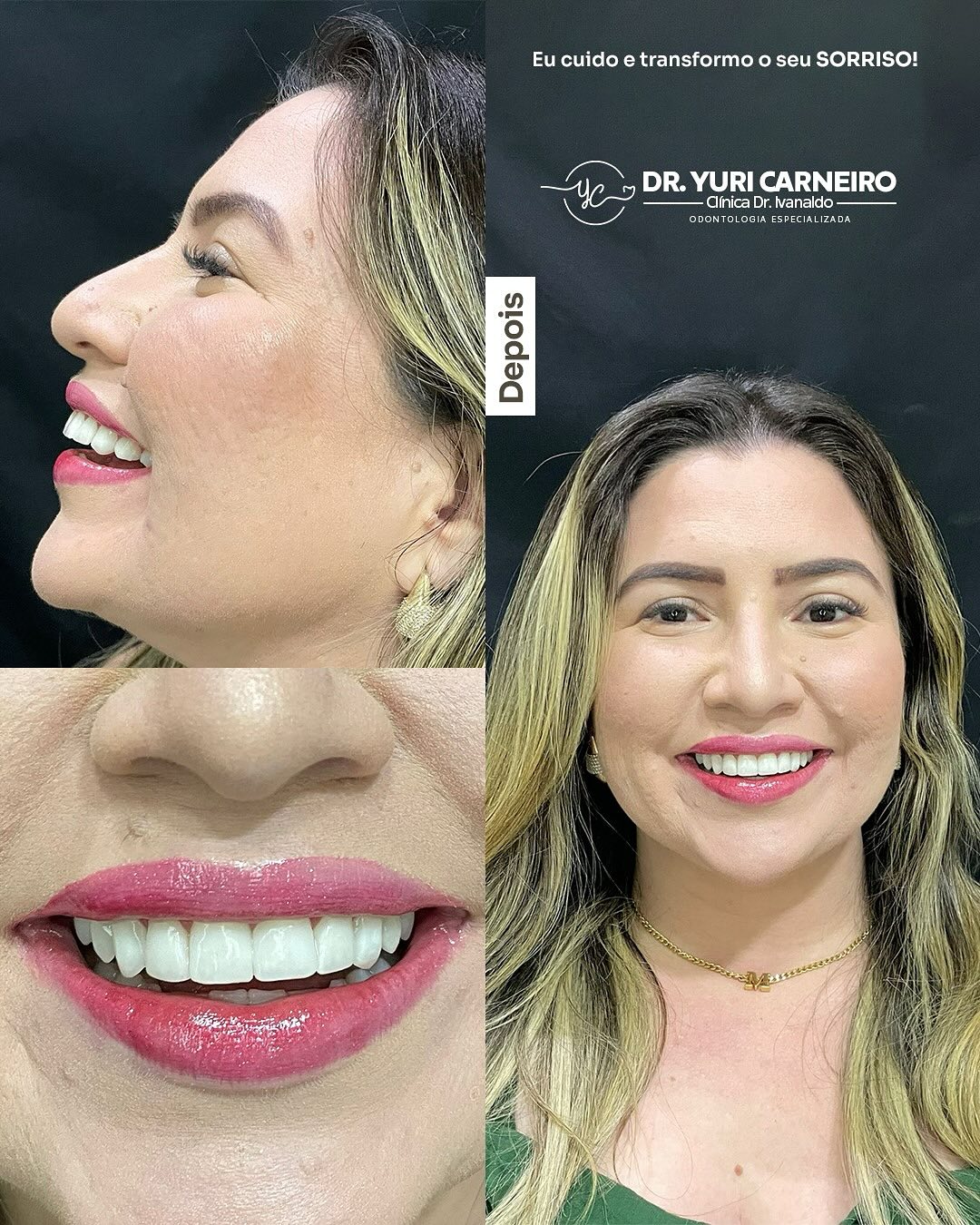 Gengivoplastia, clareamento e resina composta — registro original 3 de 5
