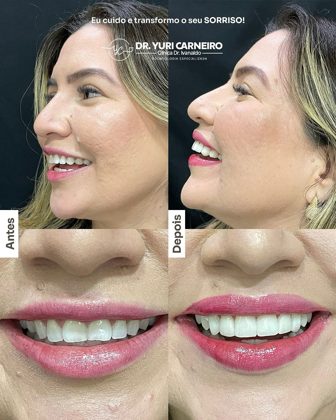Gengivoplastia, clareamento e resina composta — registro original 4 de 5