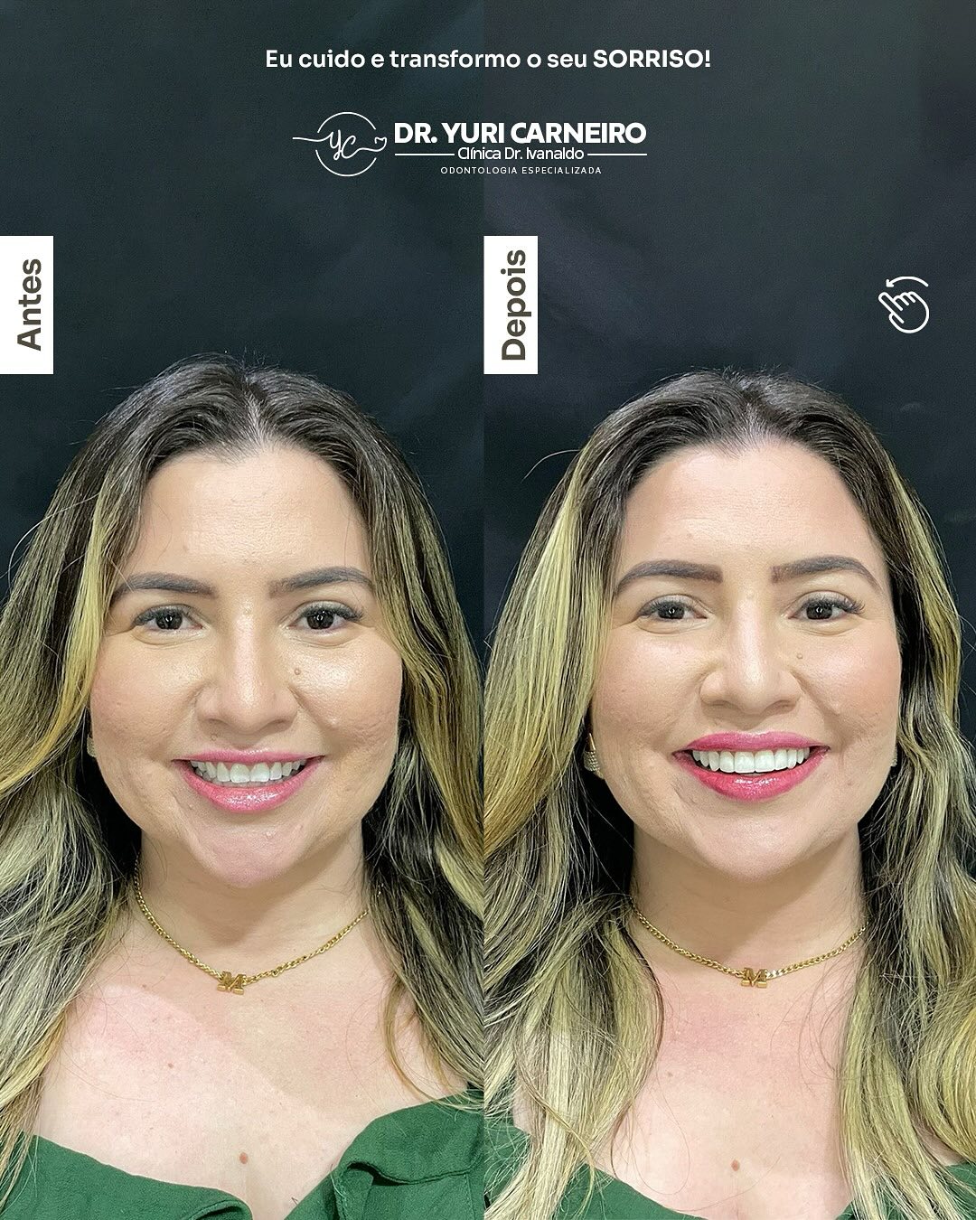 Gengivoplastia, clareamento e resina composta — registro original 5 de 5