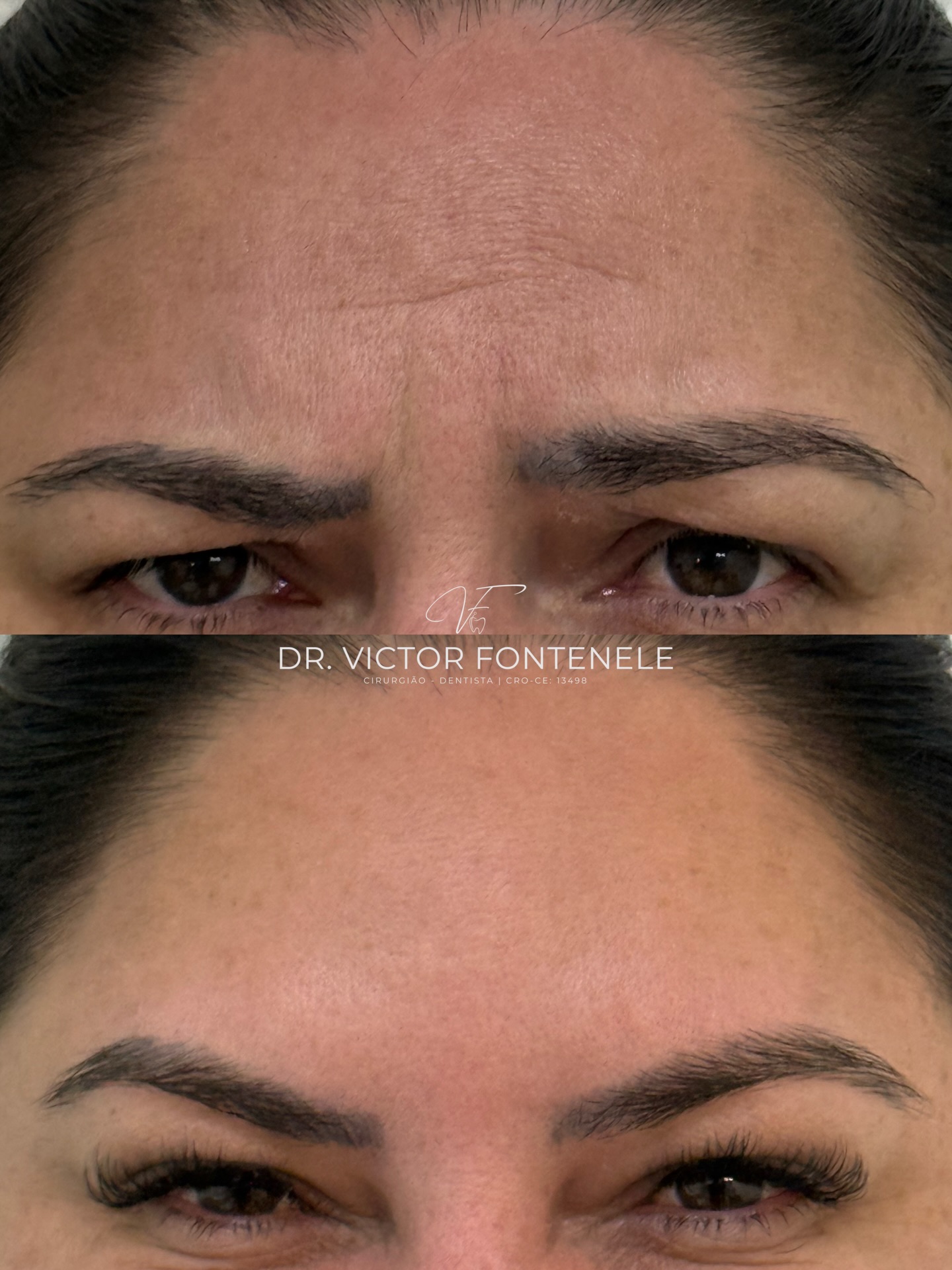 Toxina botulínica — registro original 2 de 3