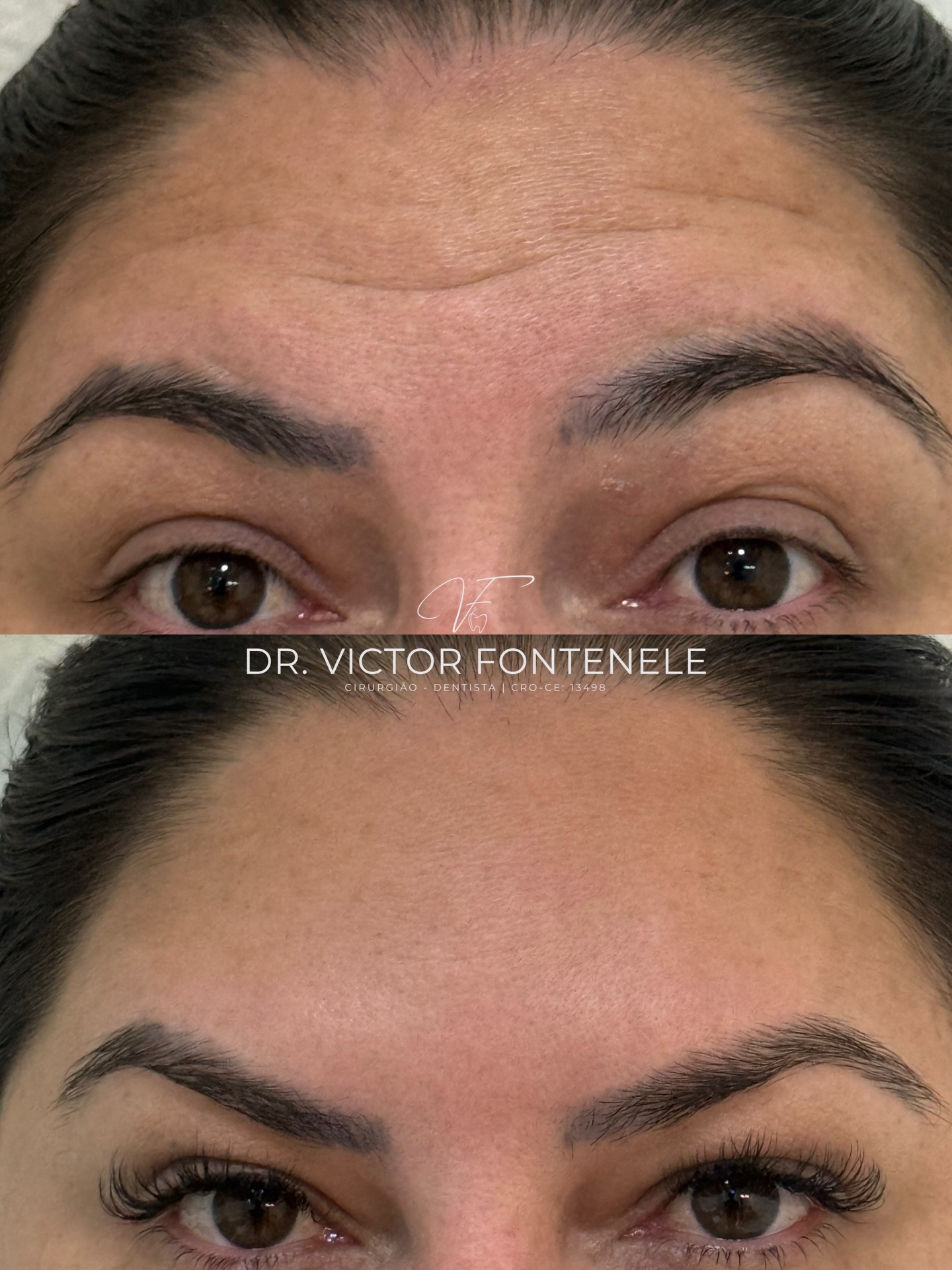 Toxina botulínica — registro original 3 de 3
